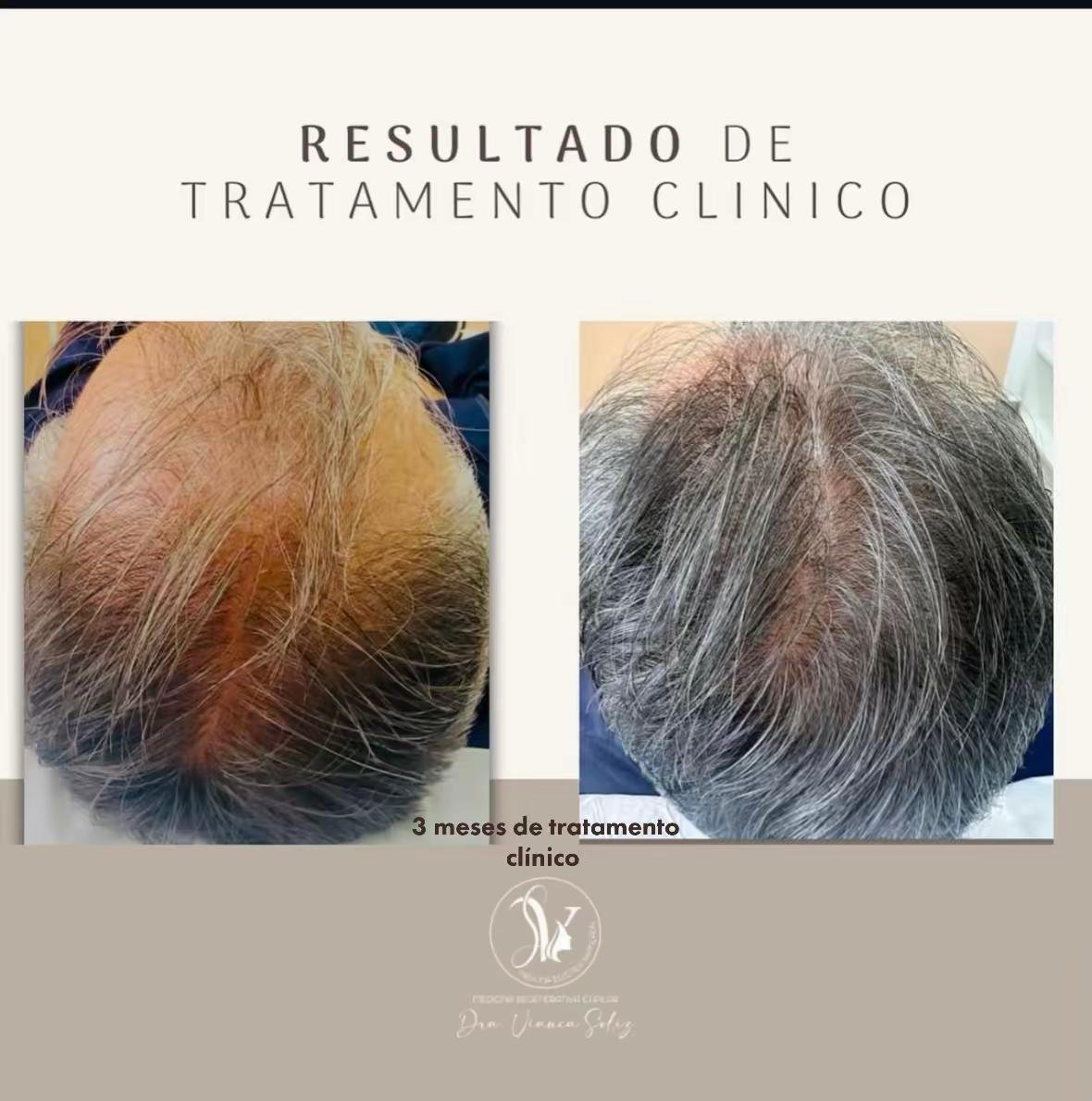 Resultado tratamiento capilar 1 — Método VS®