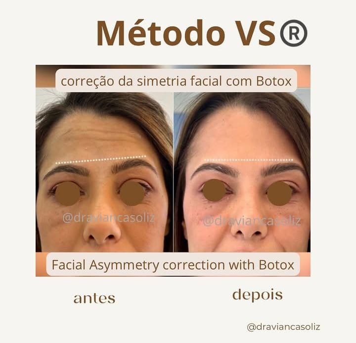 Resultado tratamiento capilar 2 — Método VS®