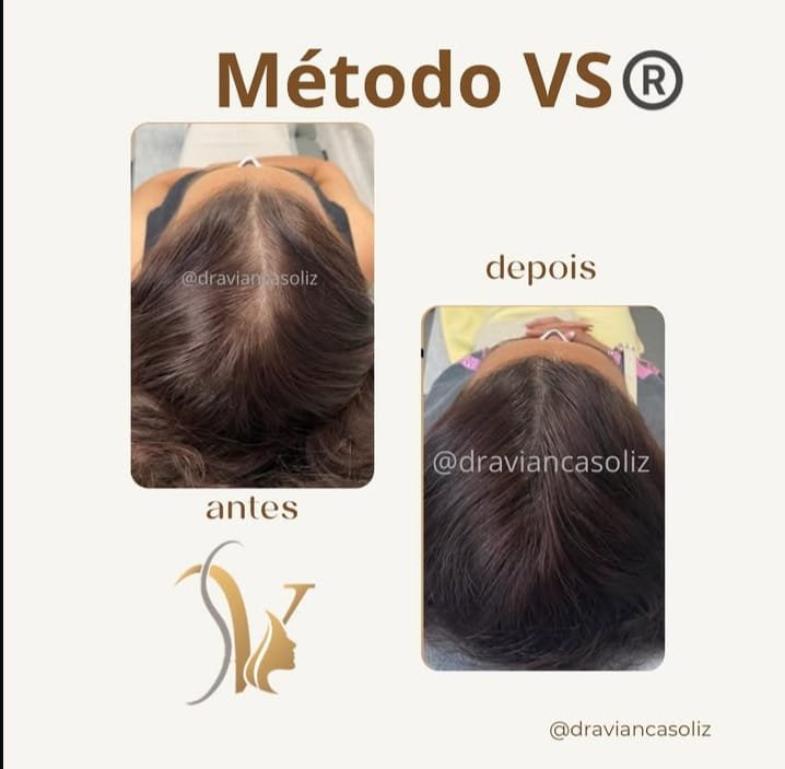 Resultado tratamiento capilar 3 — Método VS®