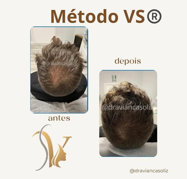 Resultado tratamiento capilar 4 — Método VS®