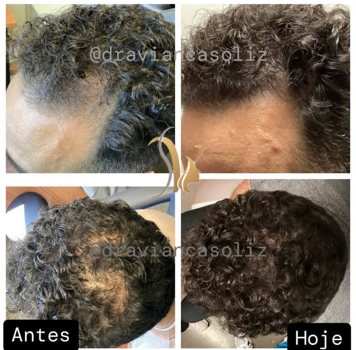 Resultado tratamiento capilar 5 — Método VS®