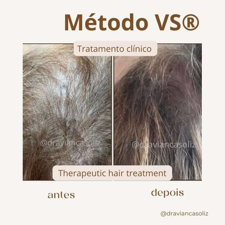 Resultado tratamiento capilar 6 — Método VS®