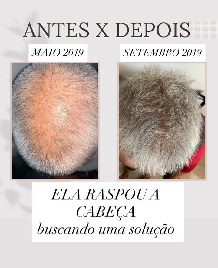 Resultado destacado Método VS® — transformación capilar